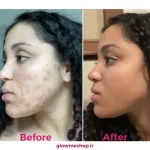 ژل ضدجوش دیفرین 30 گرم