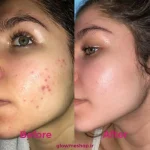 ژل ضد جوش دیفرین