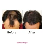 ضد ریزش آلپسین اصل